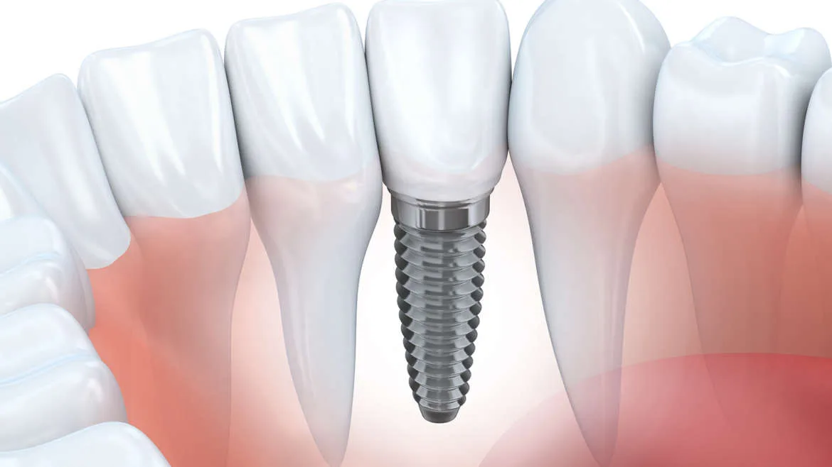 Zubné implantáty