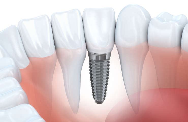 Zubné implantáty: Všetko, čo o nich potrebujete vedieť